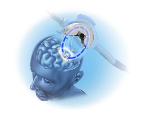 Image illustrating how precision pulse targets the brain