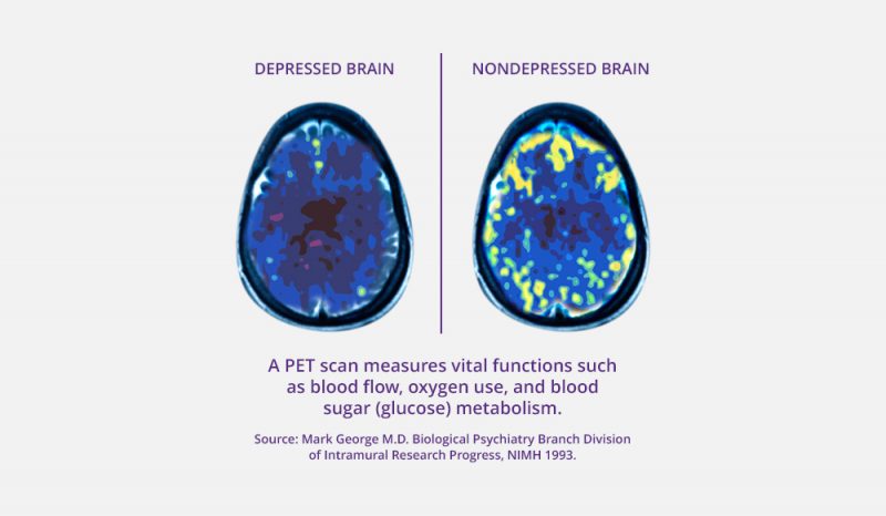 PET Brain Scan