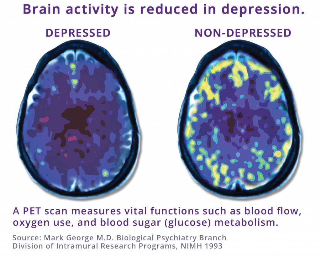 TMS Therapy for Depression Treatment | About NeuroStar | NeuroStar