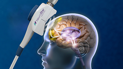 NeuroStar Advanced Therapy Step Three: Device delivers focused stimulation